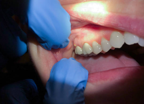 Best Lost Filling or Crown Replacement in Lancaster, SC