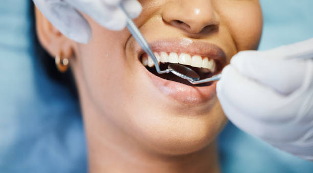 Best Knocked-Out Tooth (Avulsed Tooth) Treatment in Lancaster, SC